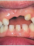 Zaburzenia zgryzu w uzębieniu mlecznym – kiedy rozpocząć leczenie ortodontyczne?