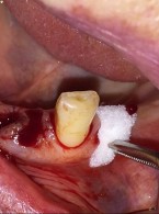 Chirurgia stomatologiczna a leki wpływające na układ krzepnięcia krwi