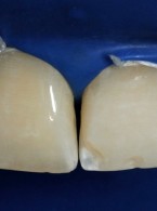 Zmiana kształtu brzegów siecznych z wykorzystaniem materiału kompozytowego 