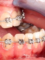 Interdyscyplinarne leczenie wad zgryzu