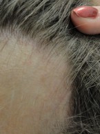 Efekt przeszczepu włosów u pacjentów z łysieniem czołowym bliznowaciejącym