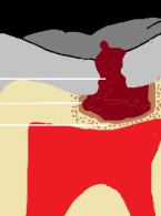 Postępowanie po odsłonięciu miazgi w zębie z niezakończonym rozwojem korzenia