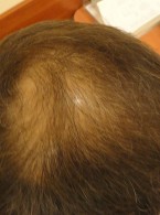 Skuteczność osocza bogatopłytkowego w leczeniu łysienia androgenowego