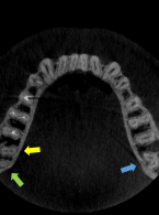 SPECJALISTA RADZI: Odbudowa protetyczna zęba trzonowego z kanałem typu C