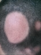 Skuteczność doustnej formy tofacitinibu w leczeniu łysienia plackowatego obejmującego okolicę brody