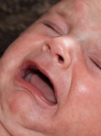 Powikłania skórne tocznia rumieniowatego noworodków