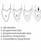SPECJALISTA RADZI: Preparacja bezstopniowa