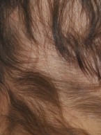 Stosowanie inhibitorów pompy protonowej zwiększa ryzyko łysienia plackowatego