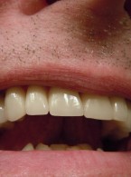 SPECJALISTA RADZI: Uszkodzenie przyczepu nabłonkowego podczas retrakcji dziąsła