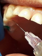 SPECJALISTA RADZI: Znieczulenie przezbrodawkowe u dzieci