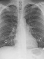 Profilaktyka pneumocystozowego zapalenia płuc z zastosowaniem trimetoprimu i sulfametoksazolu u pacjentów stosujących metotreksat