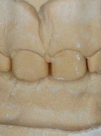 SPECJALISTA RADZI: Planowanie łuku zębowego na podstawie szerokości zęba siecznego przyśrodkowego szczęki