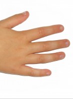 10% roztwór efinakonazolu w leczeniu grzybicy paznokci u pacjentów pediatrycznych