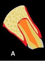 SPECJALISTA RADZI: Powikłane złamanie korony zęba z niezakończonym rozwojem