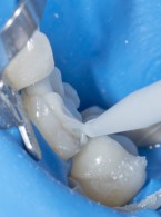 SPECJALISTA RADZI: Cementowanie adhezyjne wkładów i nakładów