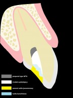 SPECJALISTA RADZI: Przebarwienie korony zęba w następstwie obliteracji systemu kanałowego