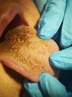 SPECJALISTA RADZI: Język czarny włochaty