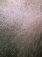 Miejscowe stosowanie dapsonu w terapii wyłysiającego zapalenia mieszków włosowych   