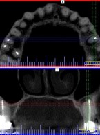 Endodoncja czy implantologia?