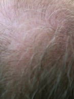 Zastosowanie adalimumabu u pacjentów z wyłysiającym zapaleniem mieszków włosowych