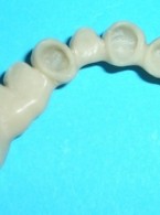 SPECJALISTA RADZI: Ochrona koroną tymczasową oszlifowanego zęba bezmiazgowego