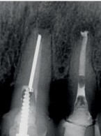 SPECJALISTA RADZI: Nieskuteczna apikotomia wierzchołka  korzenia – ponowna resekcja czy powtórne  leczenie kanałowe? 