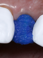 Bezpośrednia licówka kompozytowa w odcinku przednim wykonana z użyciem uniwersalnego kompozytu typu bulk-fill z uproszczonym systemem odcieni  – opis przypadku klinicznego