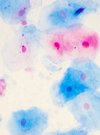 SPECJALISTA RADZI. Zakażenie HPV w jamie ustnej 