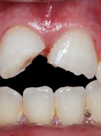 Zastosowanie kompozytów w bezpośredniej odbudowie zębów przednich po urazie