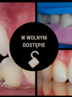 Zastosowanie kompozytów w bezpośredniej odbudowie zębów przednich po urazie