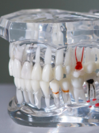 Nietypowa migracja korzenia zęba do komórek sitowych – opisu przypadku i przegląd piśmiennictwa