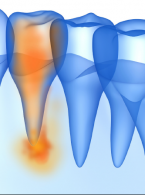 STRESZCZENIA I KOMENTARZ   Znaczne przepchnięcie pasty wodorotlenkowo-wapniowej zawierającej siarczan baru podczas leczenia endodontycznego
